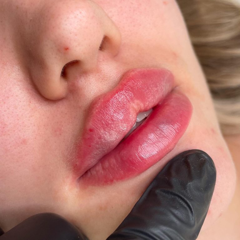 paljonko huulten täyttö maksaa