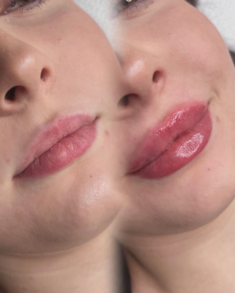 Ennen ja jälkeen huulten täyttö Tampere