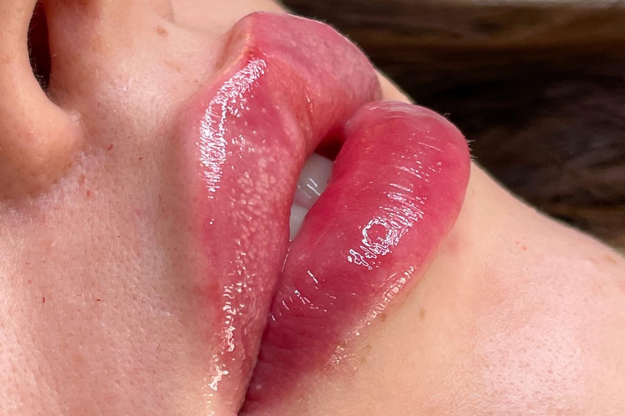 Russian lips huulten täyttö Tampere