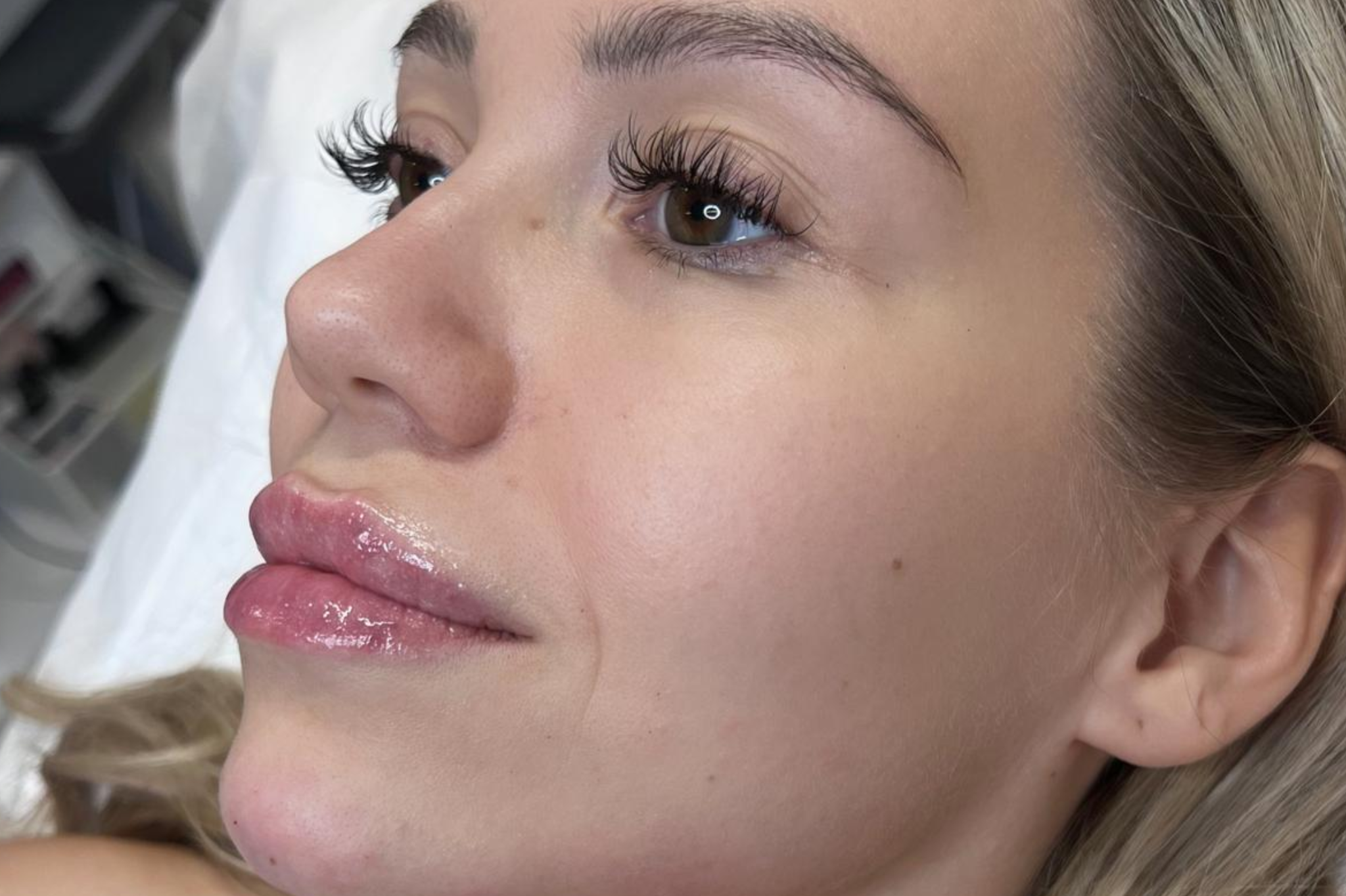 Full face täyteainehoito Tampere