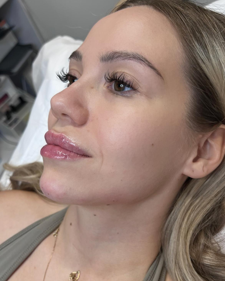 Full Face täyteainehoito | Esteettinen sairaanhoitaja Tampere