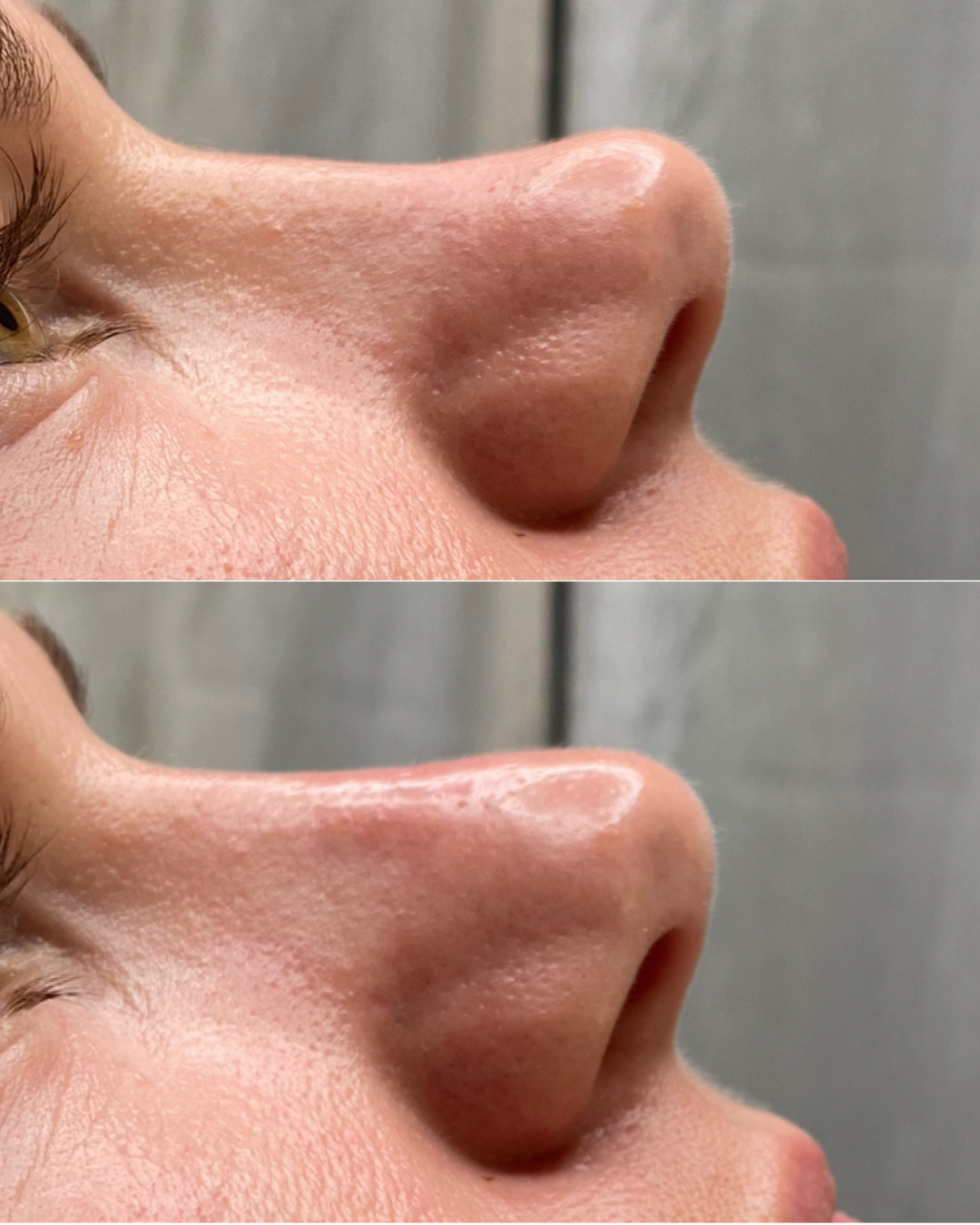 Kasvojen tasapainotus täyteaineella Tampere