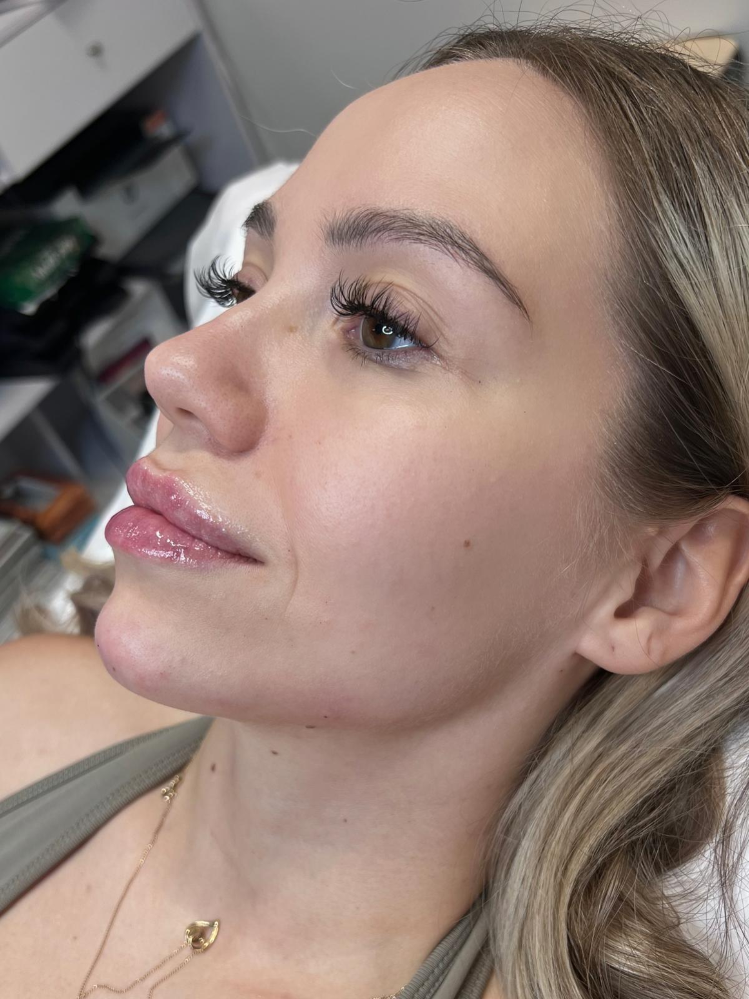 Täyteainehoidot kasvoille Tampere – Full Face