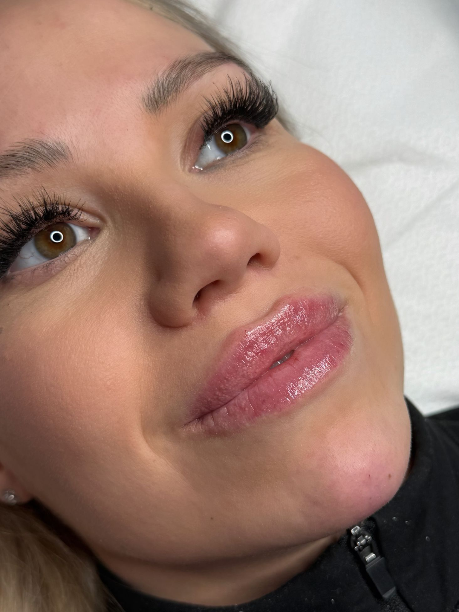 Ennen ja jälkeen full face täyteainehoito