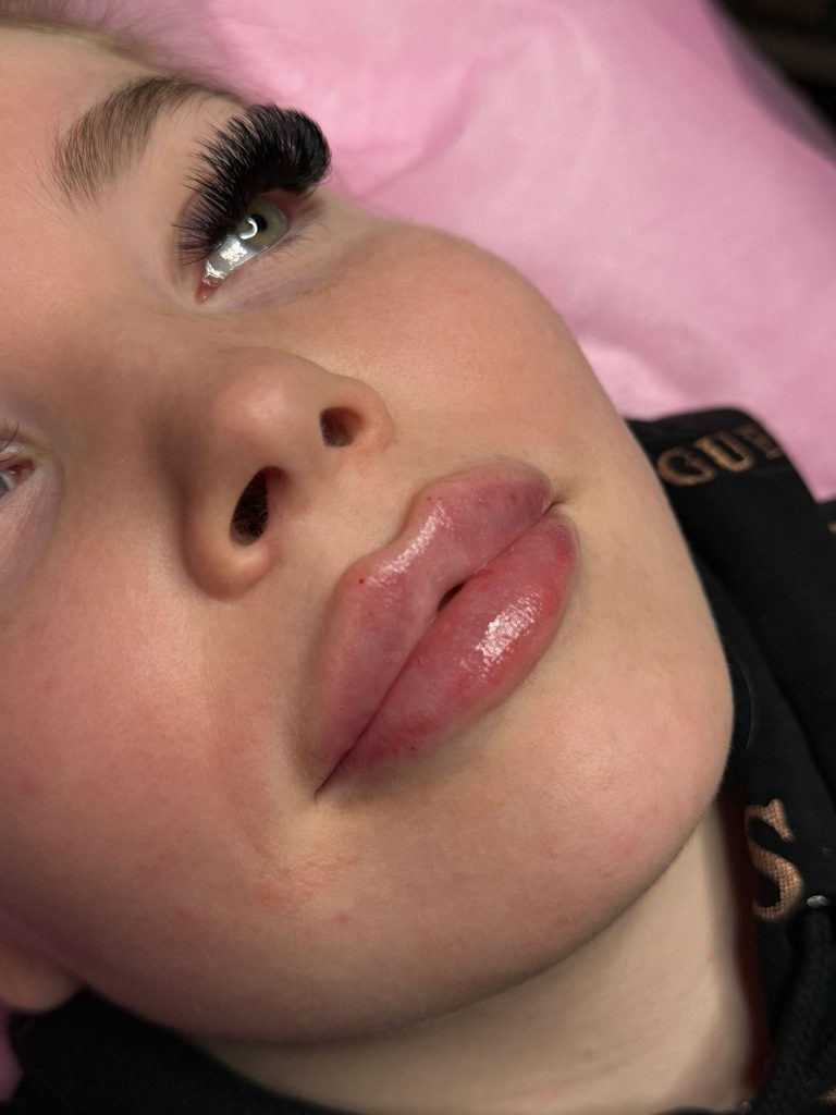 huulten volyymitäyttö