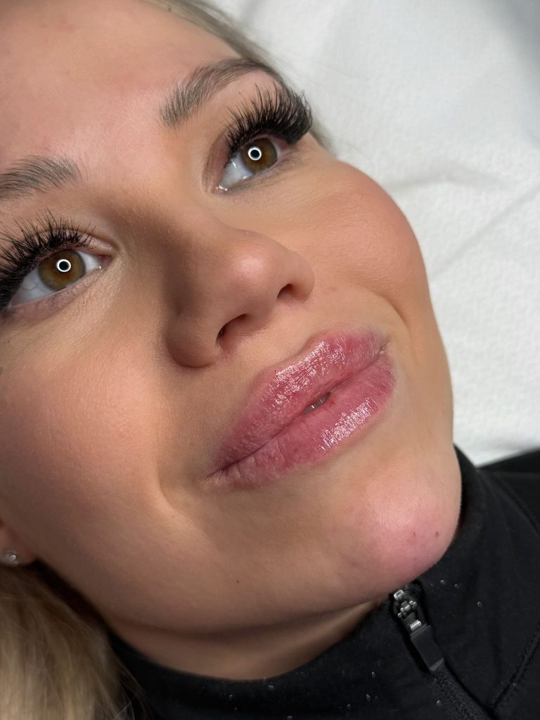 huulten täyttö Tampere