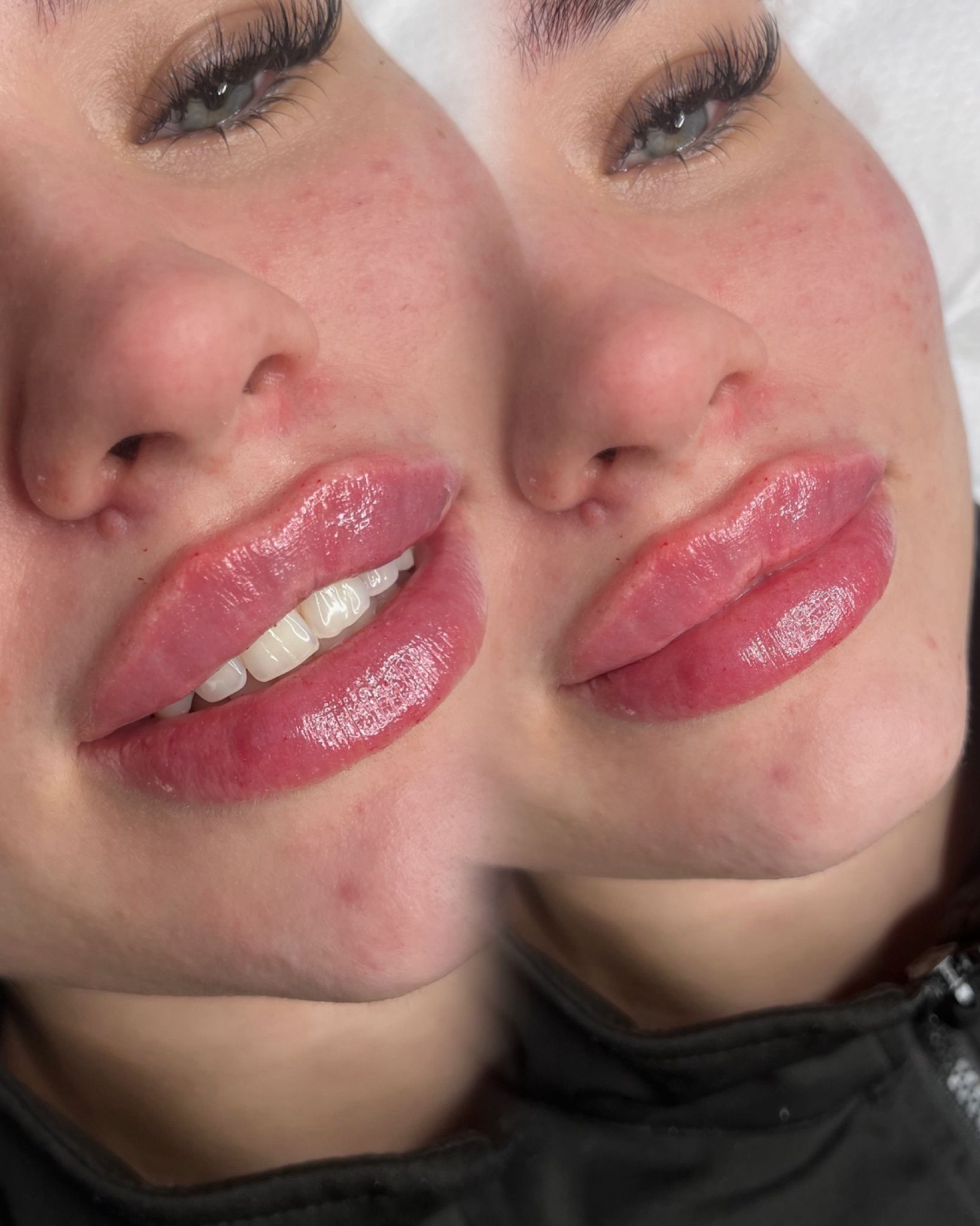 Russian lips huulten täyttö Tampere